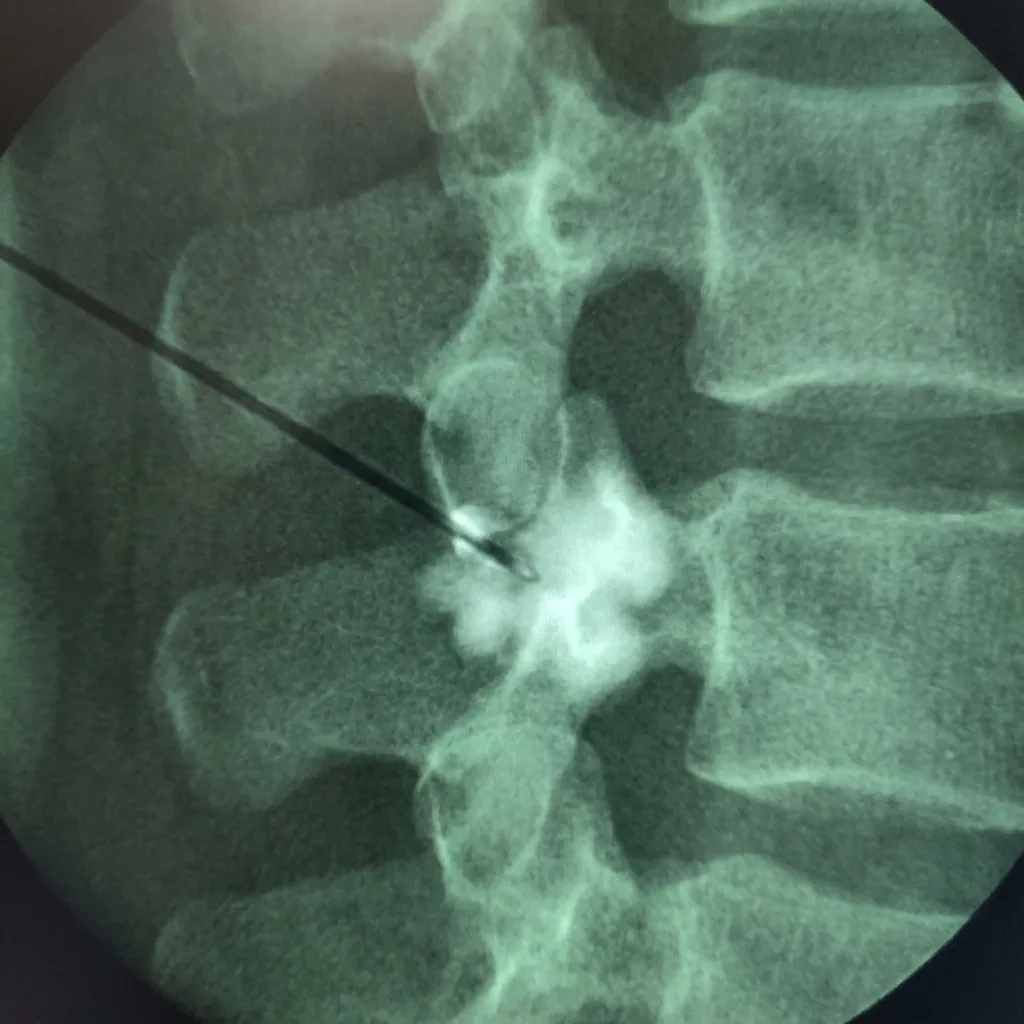 Fluoroscopic-guided needle placement for medial branch block