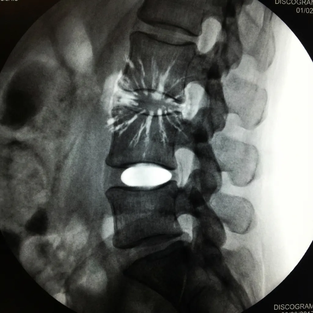 Discogram showing contrast pattern and annular morphology